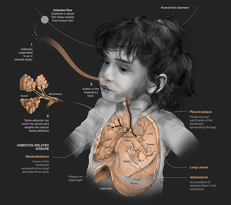Diagrams showed the effects of asbestos on the lungs.